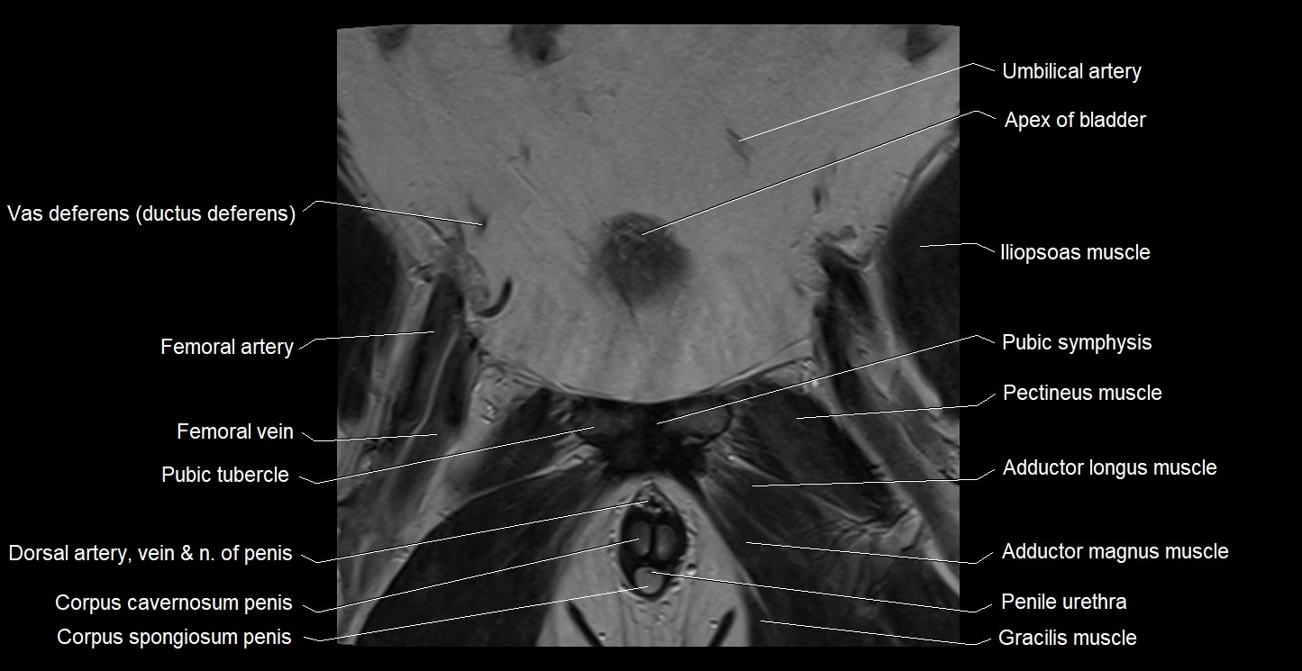 MRI coronal cross sectional anatomy male pelvis image 8.webp